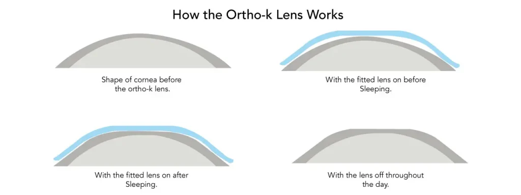 How the Ortho-K lens works